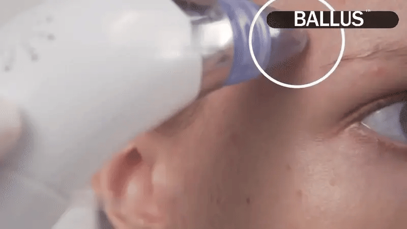 Pore Cleaning Vacuum Device – 5 Suction Levels & 4 Probes